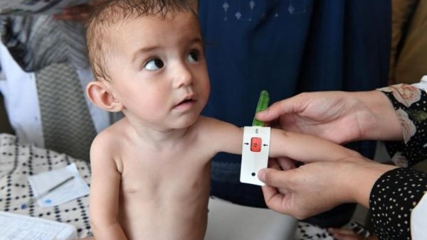 يوم الأغذية العالمي.. أرقام وإحصاءات مرعبة للجوع والتقزم والأنيميا يوم الأغذية العالمي.. أرقام وإحصاءات مرعبة للجوع والتقزم والأنيميا