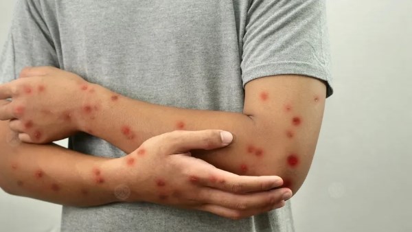  جدري القرود